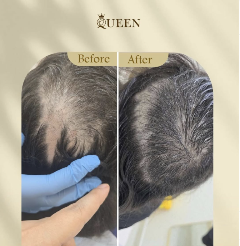 جلسات علاج تساقط الشعر