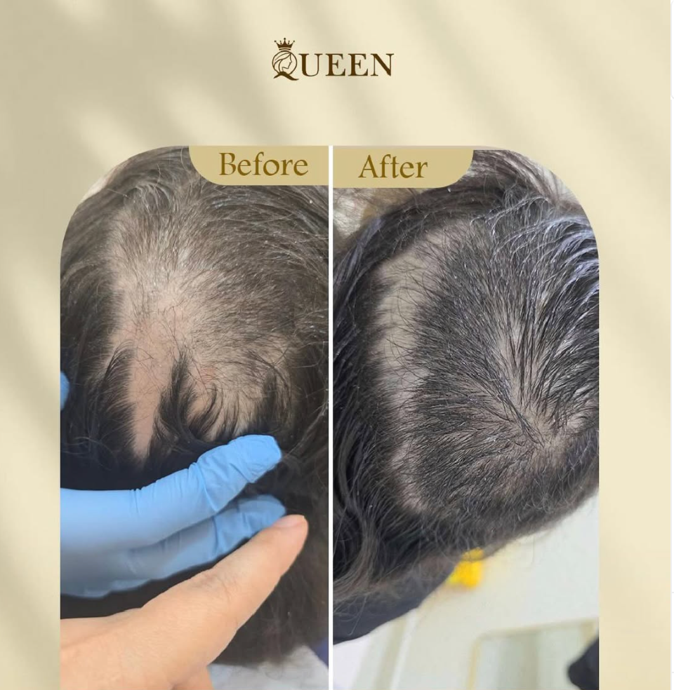 جلسات علاج تساقط الشعر