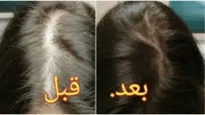 علاج تساقط الشعر للنساء بالرياض
