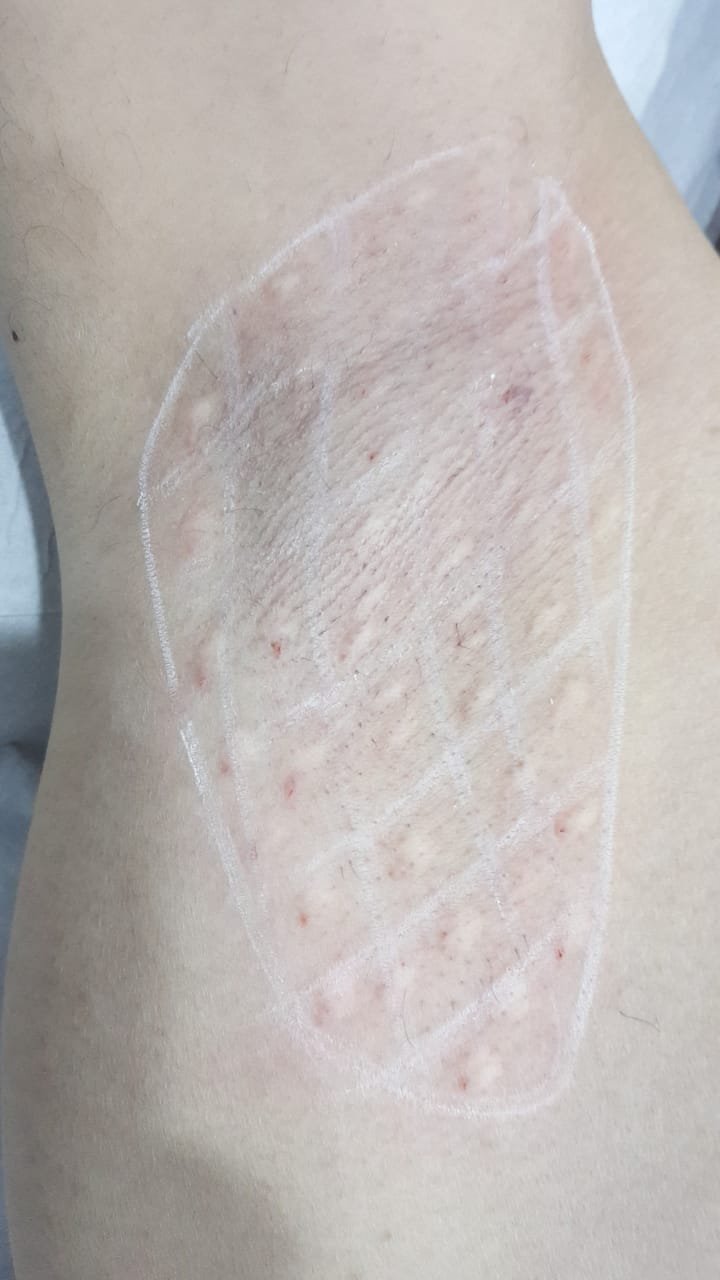 بوتكس التعرق