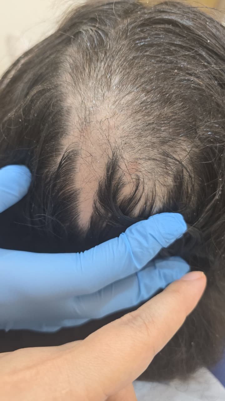 علاج الثعلبة