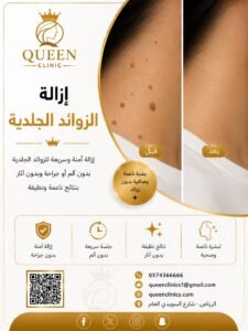 ازالة الزوايد الجلدية