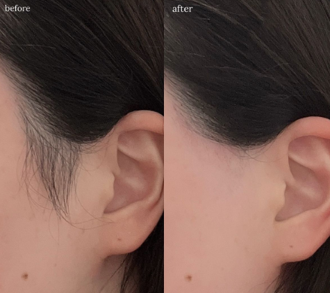 إزالة الشعر بالليزر بالرياض