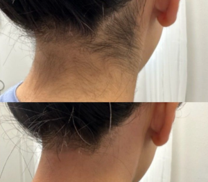 إزالة الشعر بالليزر في السويدي