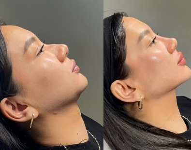 كيف أحصل على نتيجة طبيعية من عملية التجميل؟