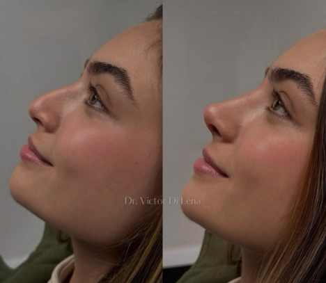 تجميل الأنف