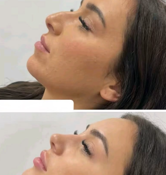 تجميل الأنف السويدي الرياض