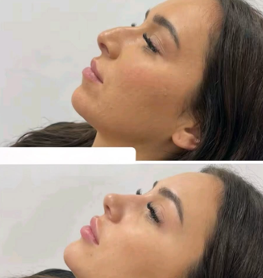 عملية تجميل الأنف في الرياض