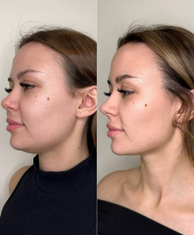 فترة التعافي بعد جراحة التجميل