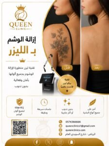 إزالة الوشم في الرياض