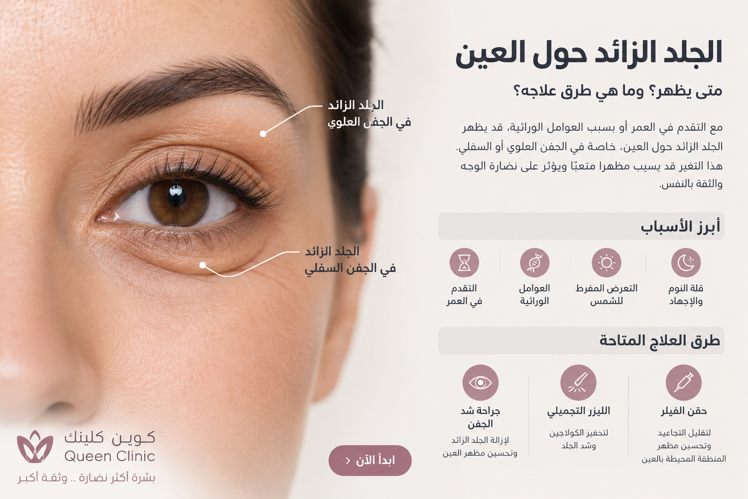 الجلد الزائد حول العين